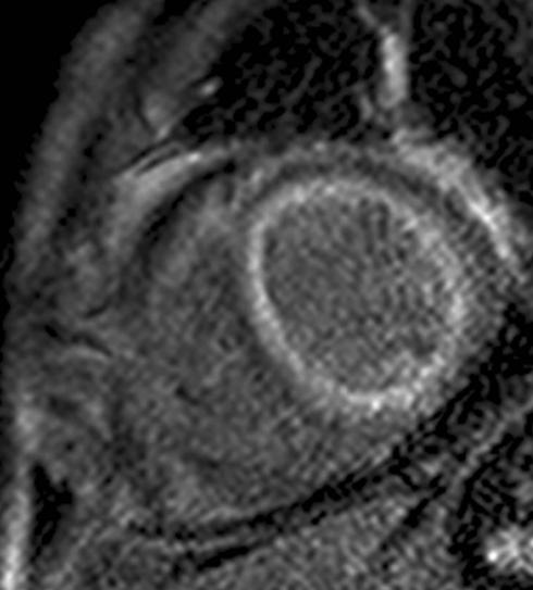 M/61, C.C.: Dyspnea, Fever (since 6 months ago)